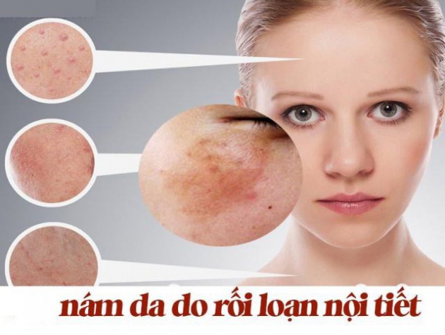 Phân biệt nám nội tiết tố và nám môi trường - đâu là giải pháp trị nám hiệu quả